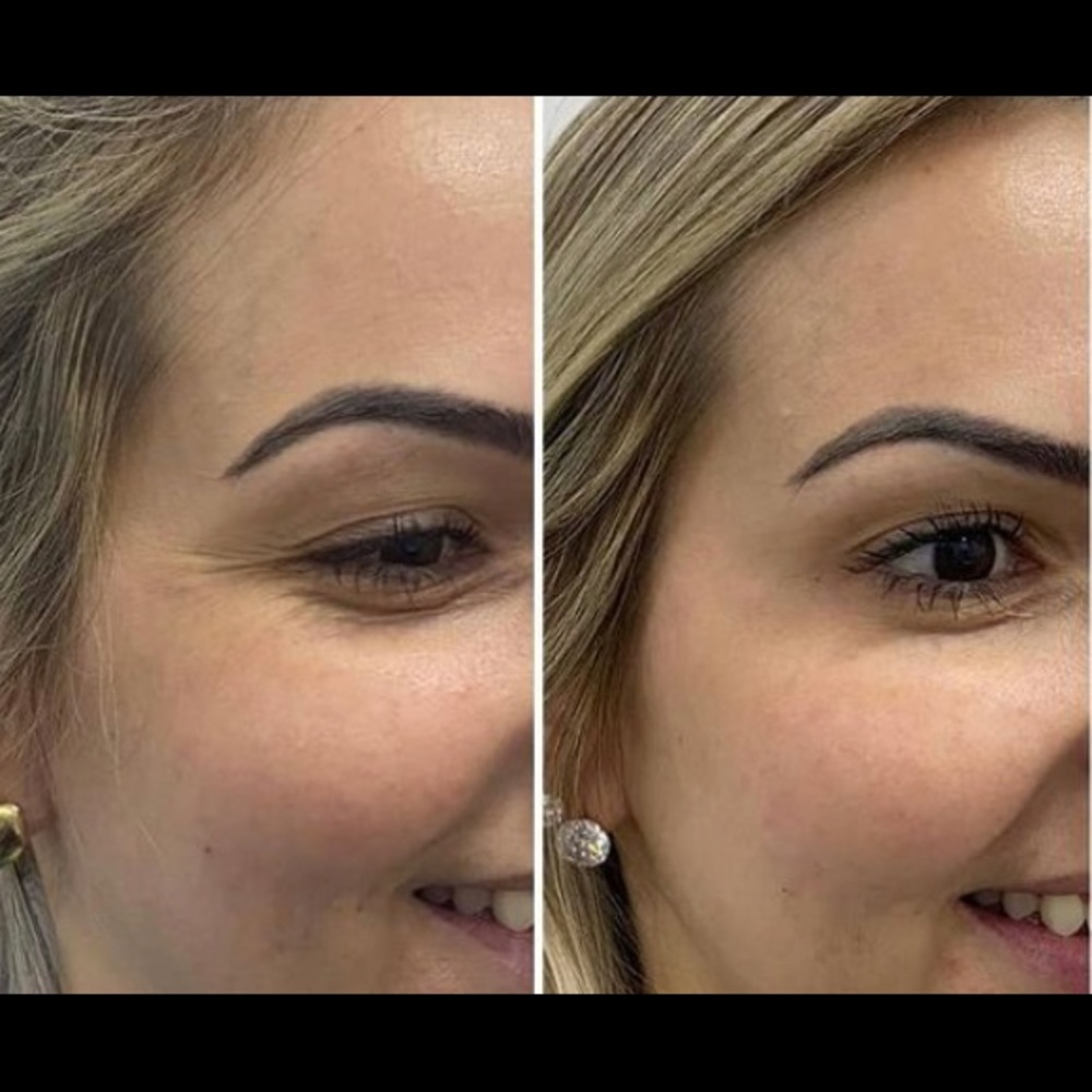 Botox